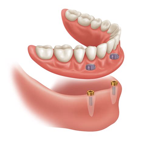 zest locator implant attachment